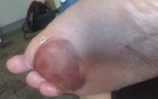 resized ri.. bruise1.jpg