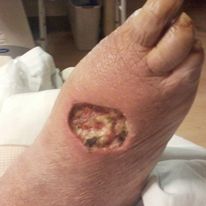 right foot healing.jpg