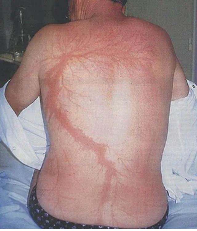 struck by lightning   a Lichtenberg figure scar.png