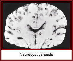 neurocysticercosis.jpg